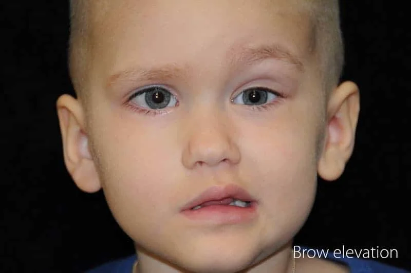 Child with forehead paralysis