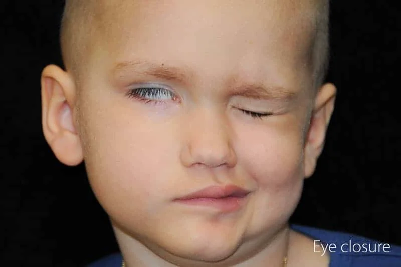Child with facial paralysis trying to close eyes