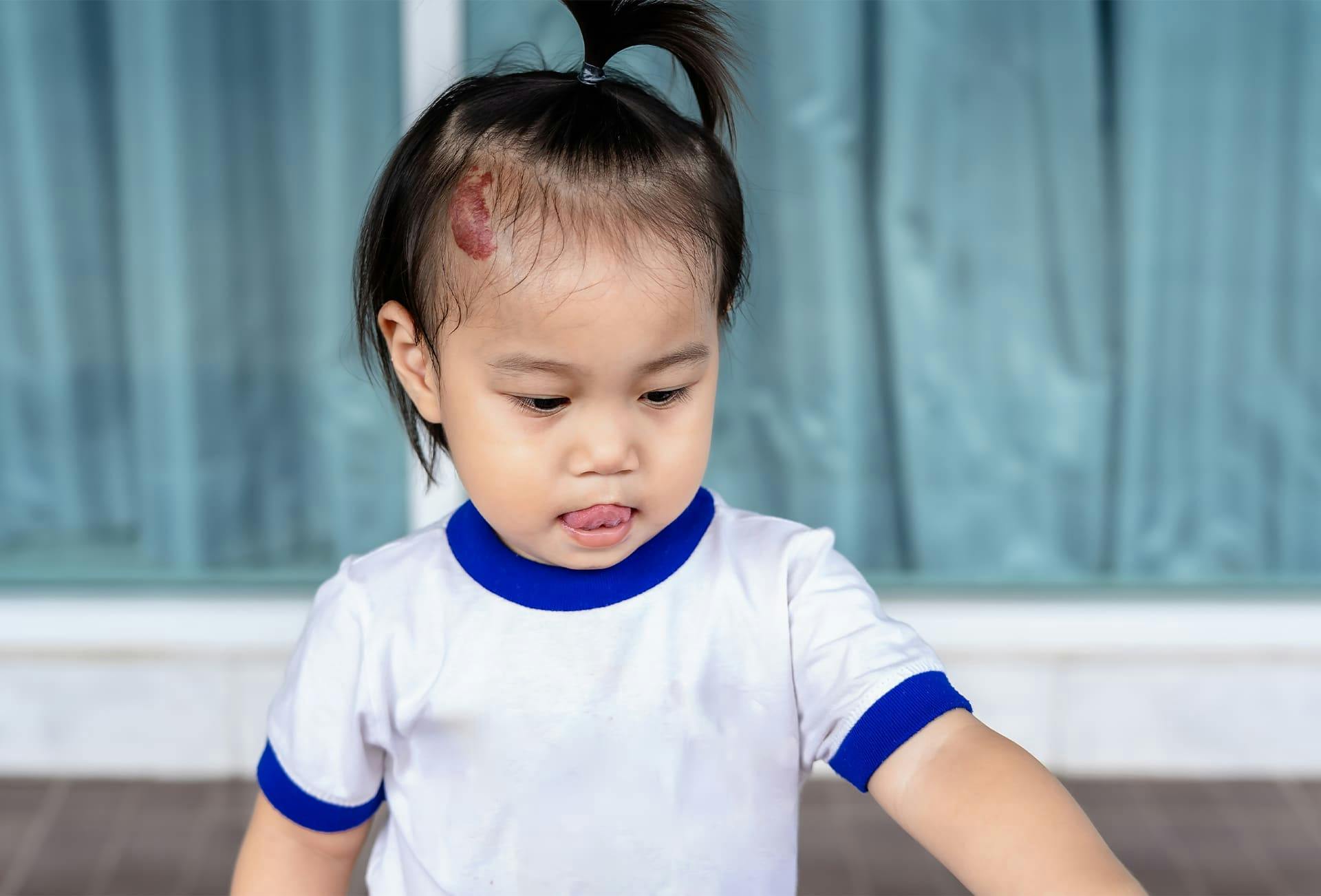Hemangioma — Dr. Panossian
