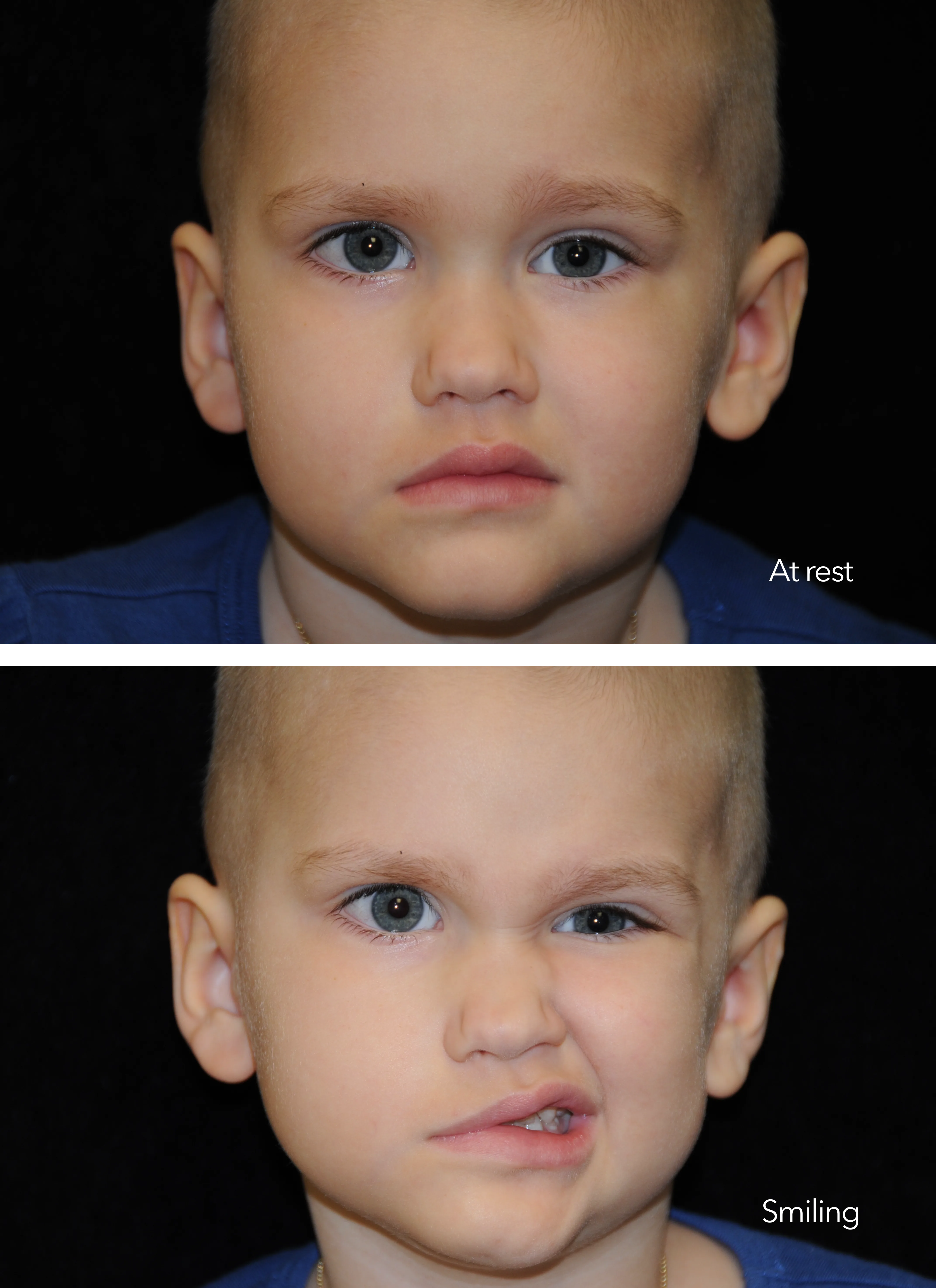 Facial paralysis patient at rest and smiling — before and after smile reanimation