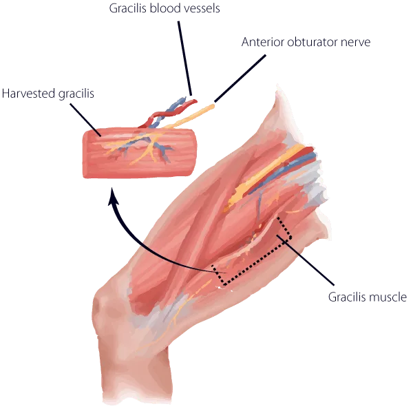 Gracilis muscle transfer surgical diagram