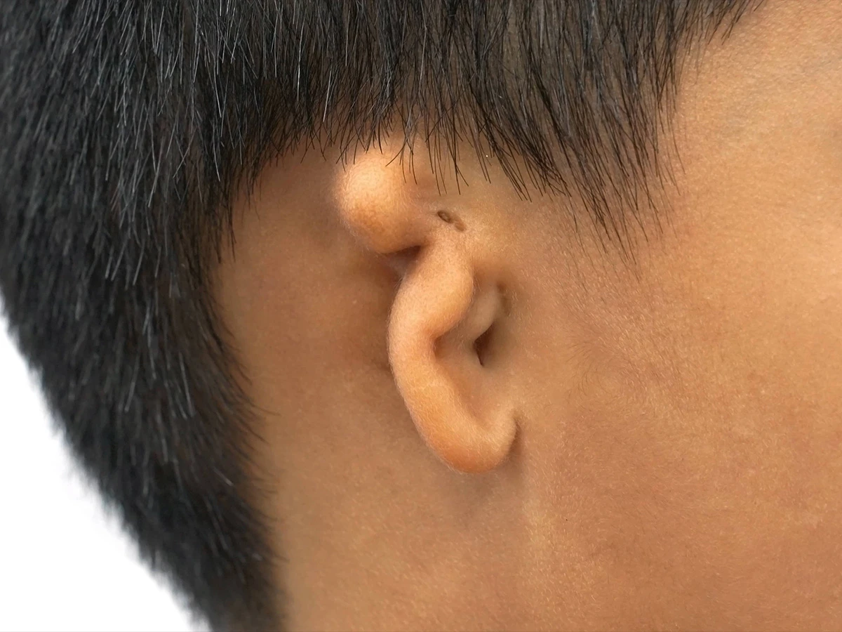 Factors to Determine Microtia Grading