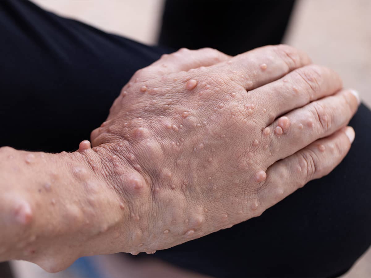 Managing Schwannomatosis
