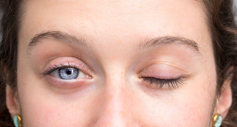 Challenges and Eye Complications of Bell's Palsy