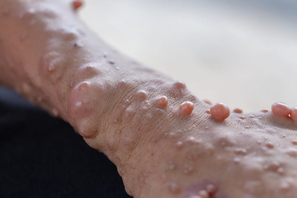 Neurofibromatosis: Managing Symptoms and Effective Treatments