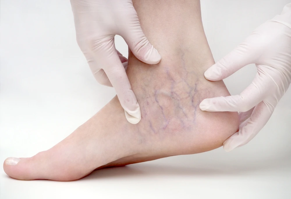 What You Need to Know About Venous Malformations