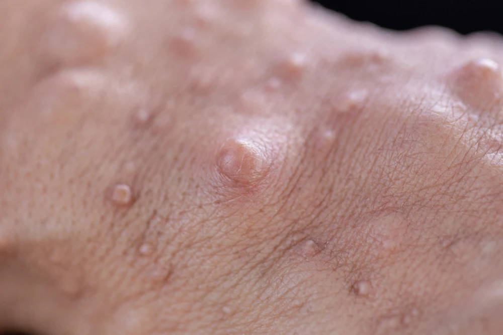 The Role of ICD-10 in Neurofibromatosis
