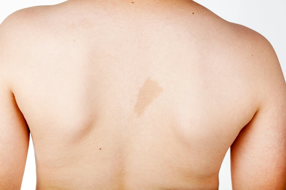 Café au Lait Spots and Neurofibromatosis