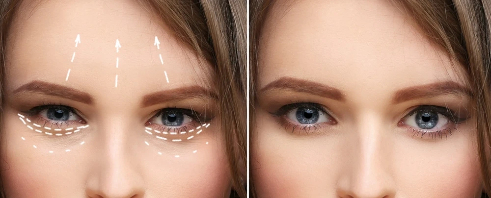 Mini Facelift: Pros and Cons