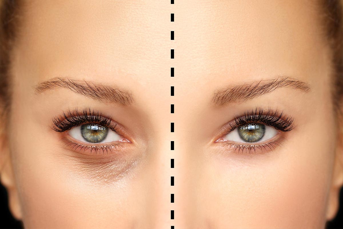 Recovery Timeline After Lower Blepharoplasty