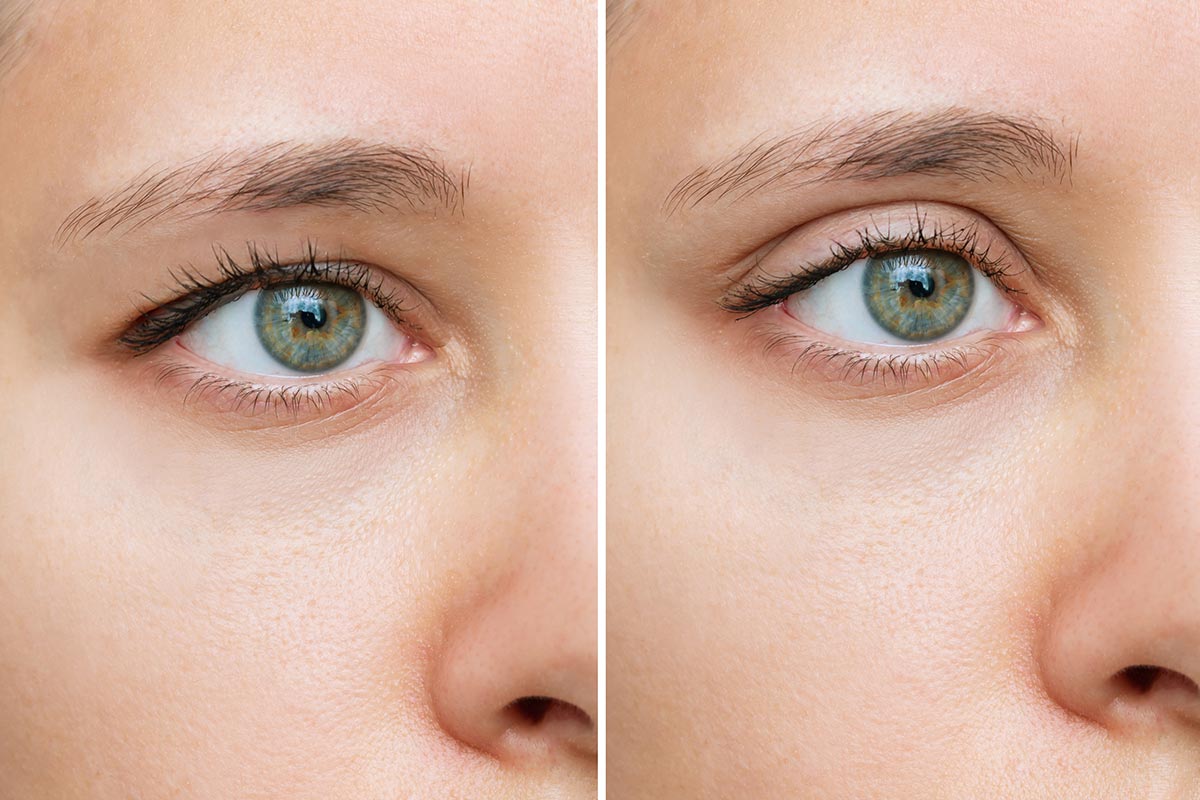 Blepharoplasty for Hooded Eyes