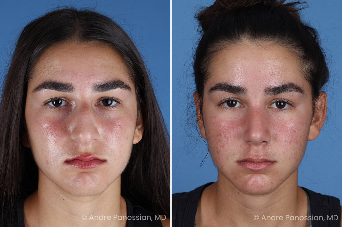Rhinoplasty before and after — actual patient of Andre Panossian, MD