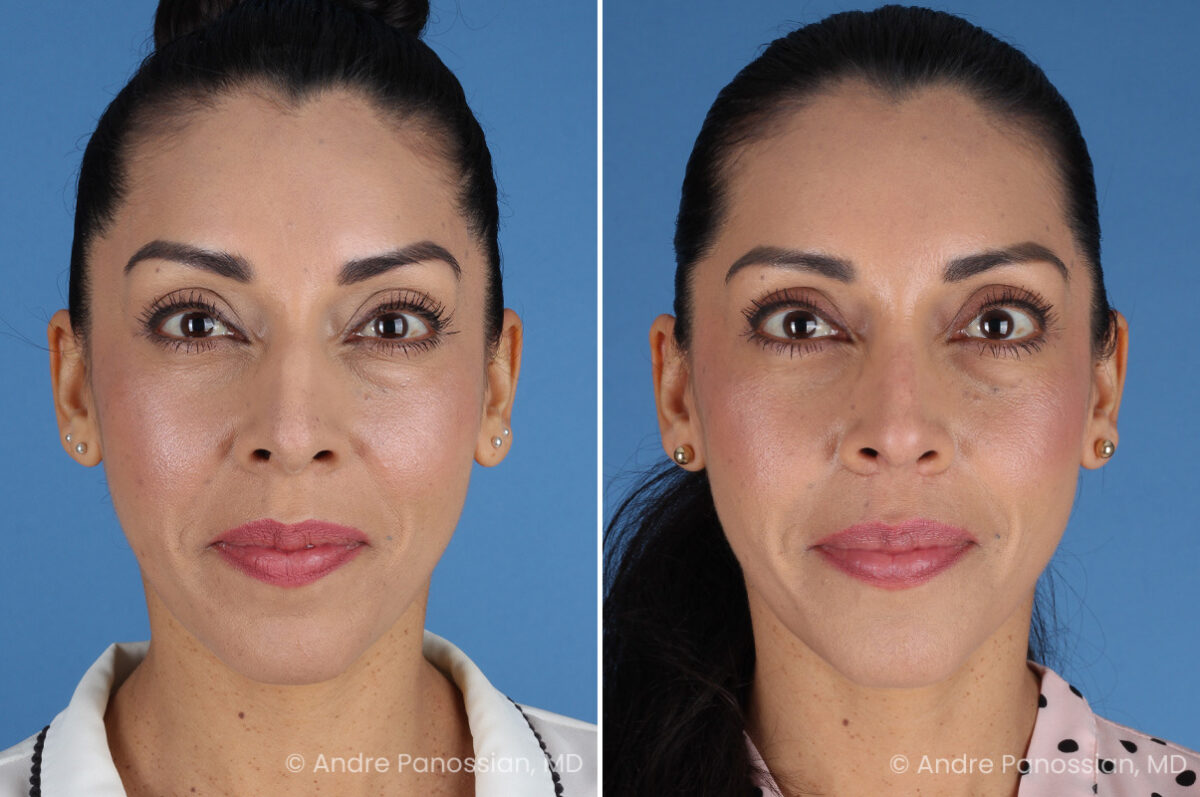Rhinoplasty before and after — actual patient of Andre Panossian, MD