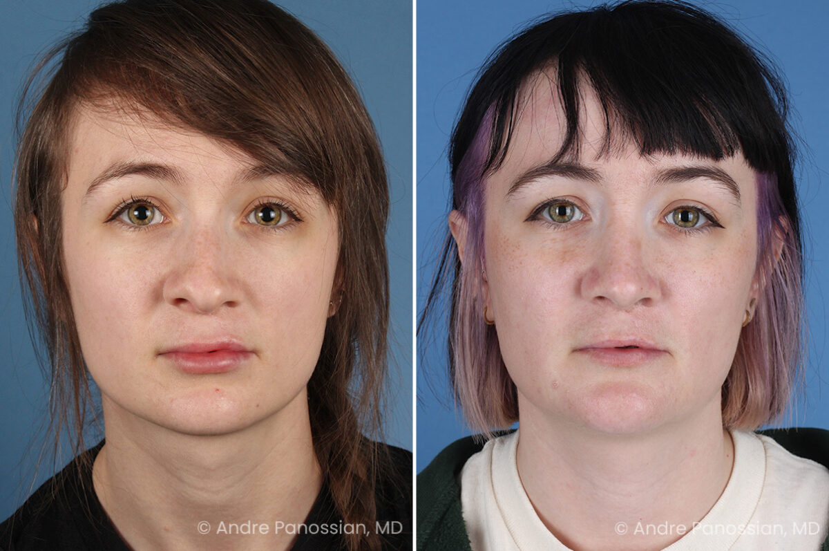 Cleft rhinoplasty before and after — actual patient of Andre Panossian, MD