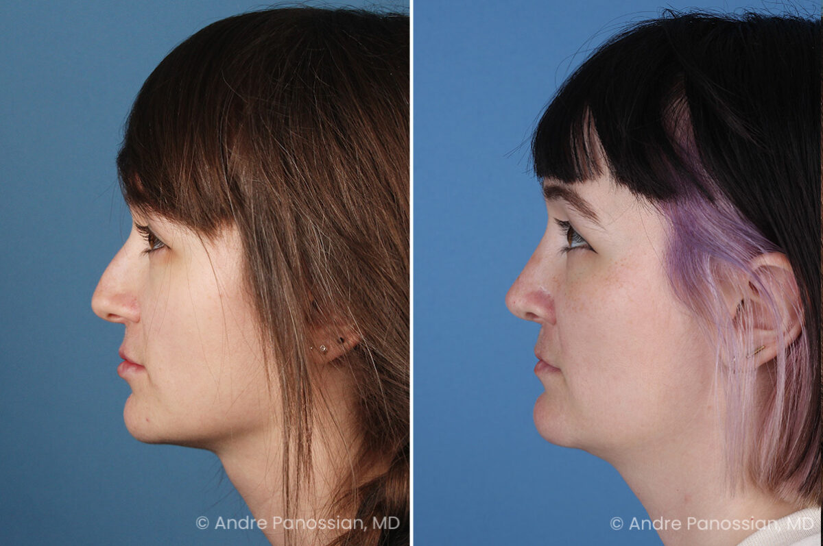 Cleft rhinoplasty before and after — actual patient of Andre Panossian, MD