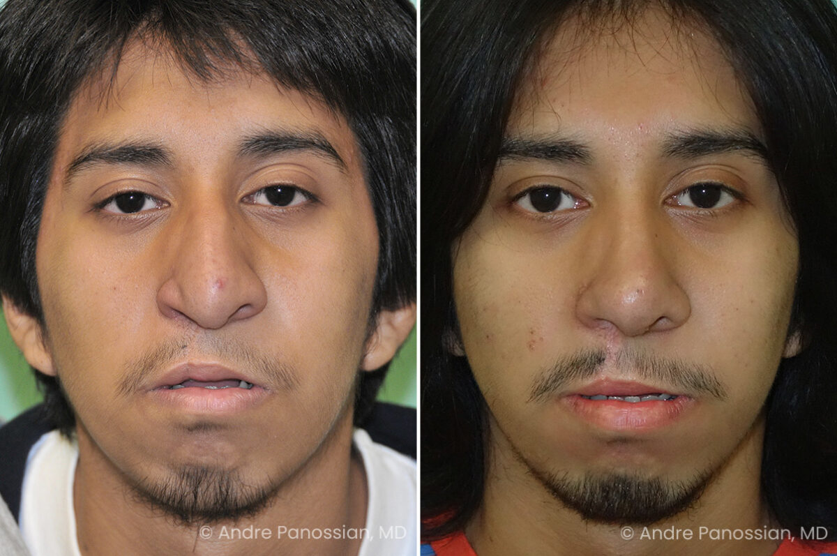 Cleft rhinoplasty before and after — actual patient of Andre Panossian, MD
