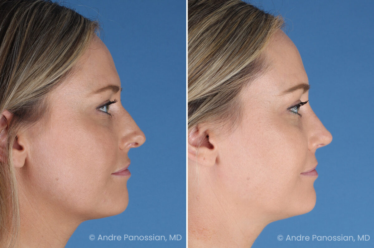 Rhinoplasty before and after — actual patient of Andre Panossian, MD