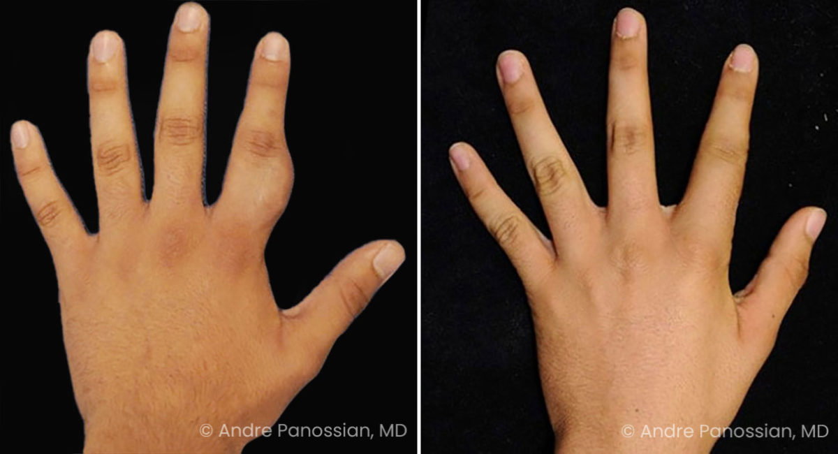 Neurofibroma removal & reconstruction before and after — actual patient of Andre Panossian, MD