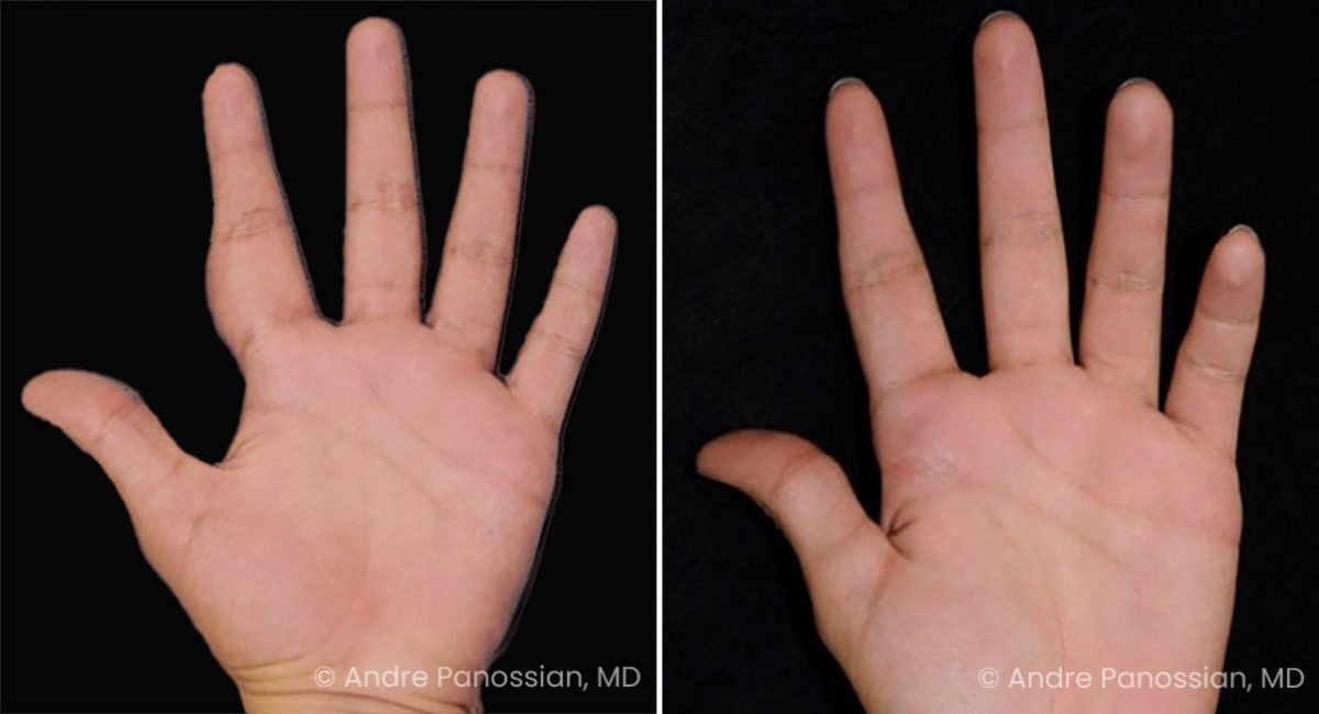 Neurofibroma removal & reconstruction before and after — actual patient of Andre Panossian, MD
