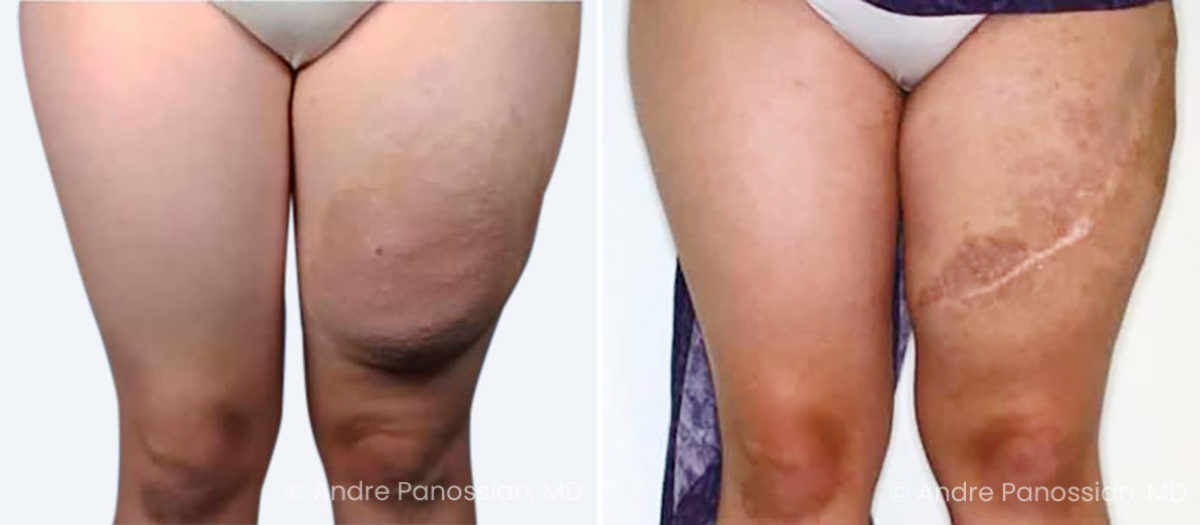 Neurofibroma removal & reconstruction before and after — actual patient of Andre Panossian, MD