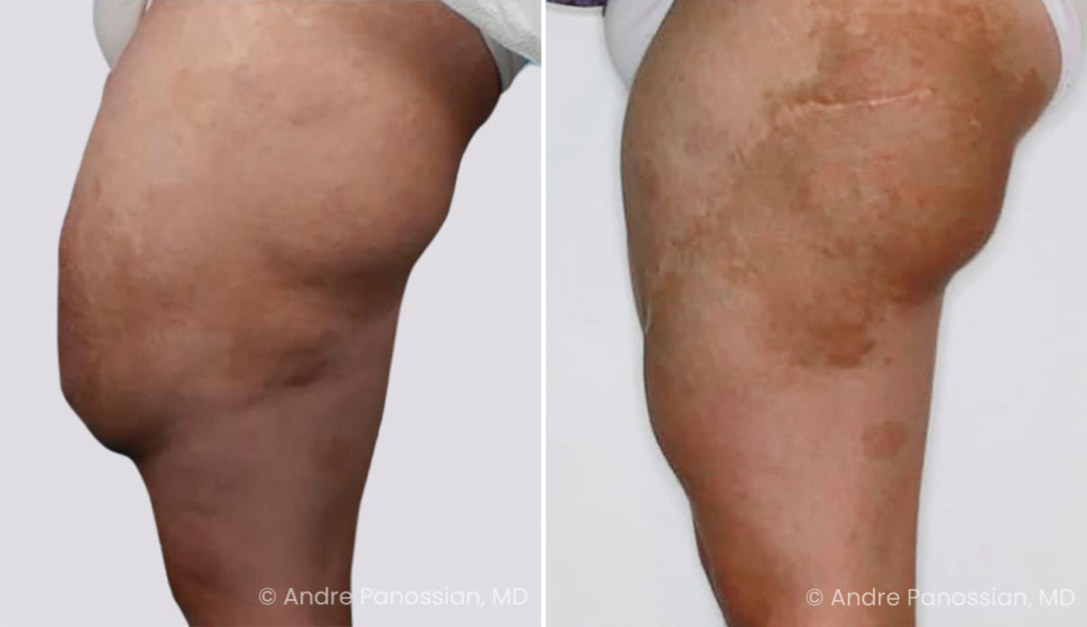 Neurofibroma removal & reconstruction before and after — actual patient of Andre Panossian, MD