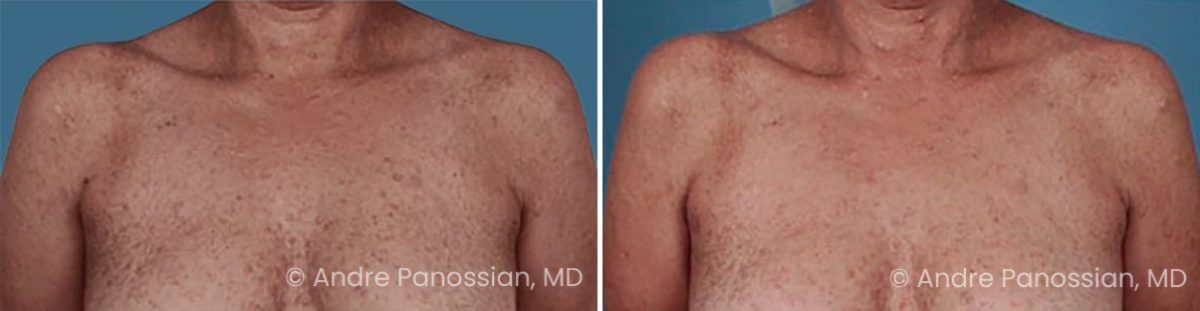 Neurofibroma removal & reconstruction before and after — actual patient of Andre Panossian, MD