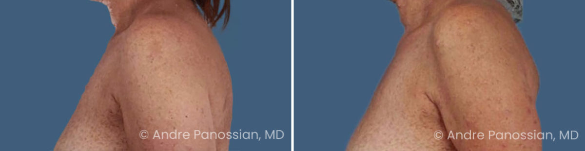 Neurofibroma removal & reconstruction before and after — actual patient of Andre Panossian, MD