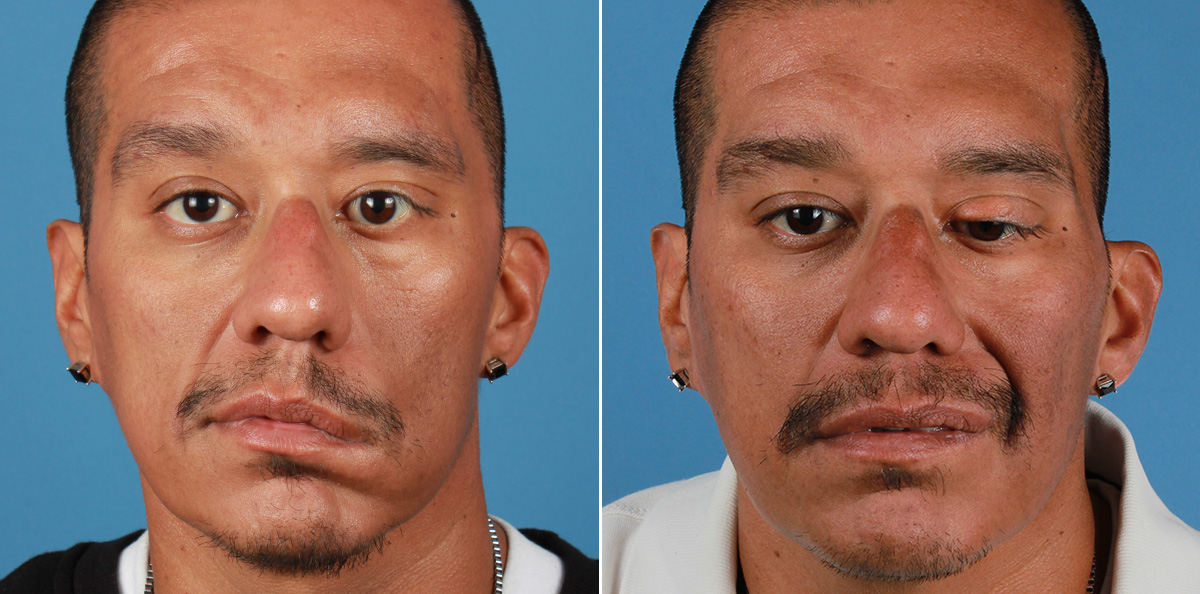 Facial reanimation — smile restoration before and after — actual patient of Andre Panossian, MD