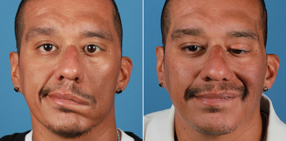 Facial reanimation — smile restoration before and after — actual patient of Andre Panossian, MD