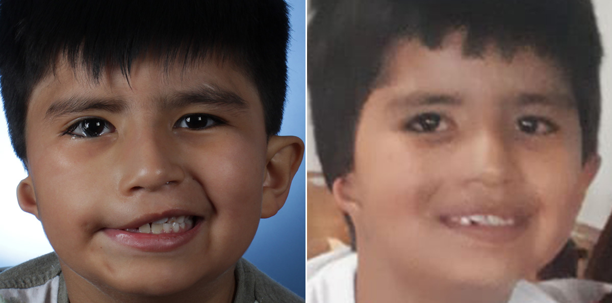 Facial reanimation — smile restoration before and after — actual patient of Andre Panossian, MD