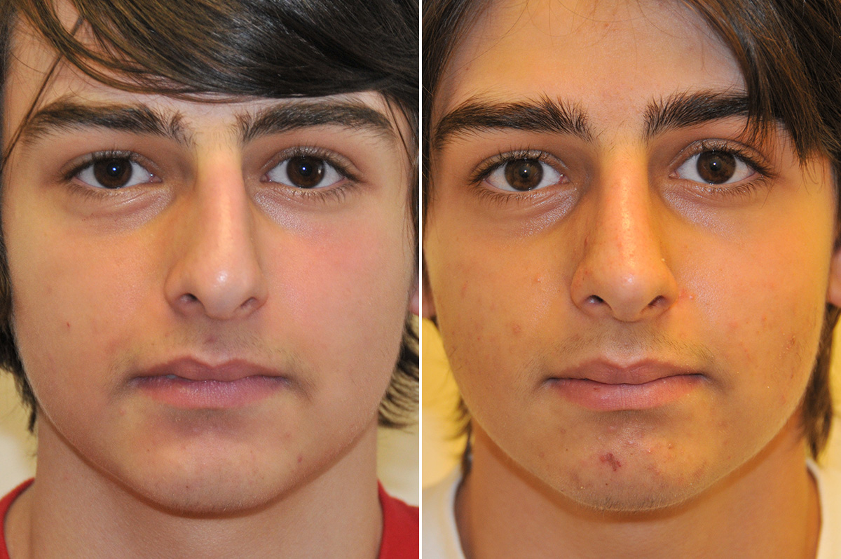 Rhinoplasty before and after — actual patient of Andre Panossian, MD