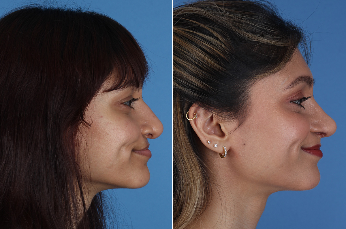 Cleft rhinoplasty before and after — actual patient of Andre Panossian, MD