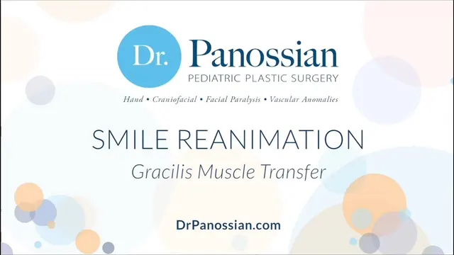 From Bell's Palsy to Full Reanimation