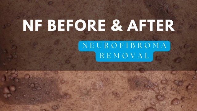 Before and After of NF1 Surgery for Tumor Removal